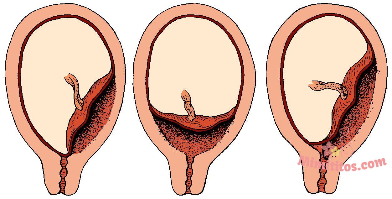¿Qué es la placenta previa?